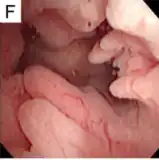 Multiple endometrial polyp