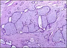 Histopathologic image of breast fibroadenoma showing proliferation of intralobular stroma compressing and distorting the epithelium. H&E stain.