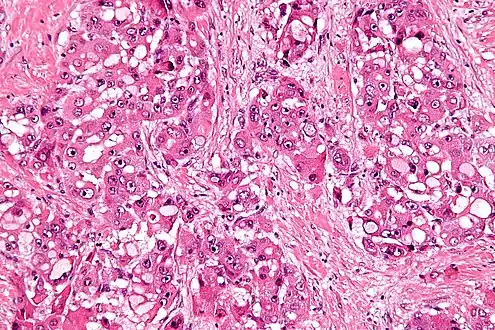 High mag.Fibrolamellar hepatocellular carcinoma