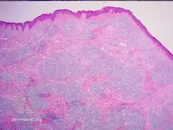 IgG4-related skin disease pathology