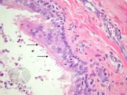 pathology-Bronchogenic cyst