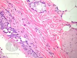 pathology-Bronchogenic cyst