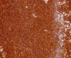 Plasmacytoma/pathology