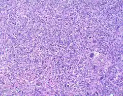 Myxofibrosarcoma-pathology