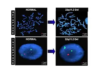 Result of FISH analysis using LSI probe (TUPLE 1) from DiGeorge/velocardiofacial syndrome critical region. TUPLE 1 (HIRA) probe was labeled in Spectrum Orange and Arylsulfatase A (ARSA) in Spectrum Green as control. Absence of the orange signal indicates deletion of the TUPLE 1 locus at 22q11.2.