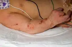 Focal dermal hypoplasia