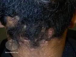 Acne keloidalis