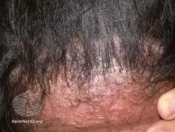Acne keloidalis