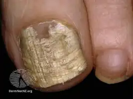 Fusarium infection