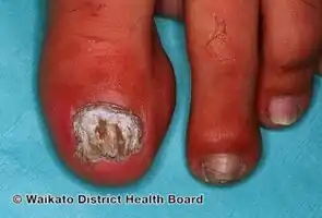 Fusarium infection
