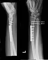 Galeazzi fracture after surgical fixation