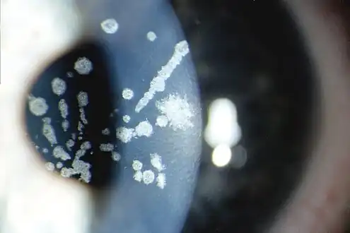 Granular corneal dystrophy type II, Variable sized crumb-like opacities in the corneal stroma that have become fused in areas giving rise to elongated and stellate shapes