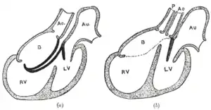 Diagrams to illustrate the transformation of the bulbus cordis. Ao. Truncus arteriosus. Au. Atrium. B. Bulbus cordis. RV. Right ventricle. LV. Left ventricle. P. Pulmonary artery.