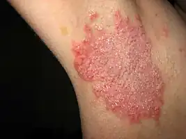 Right armpit skin affected during Hailey-Hailey disease flare