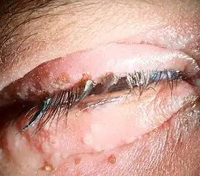herpetic blepharitis