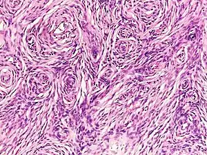 Histopathology of neurofibroma: A spindle cell lesion composed of slender fibroblast-like cells with storiform pattern and very low amount of stroma.