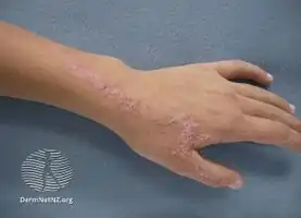 Inflammatory linear verrucous naevus