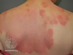 Interstitial granulomatous dermatitis