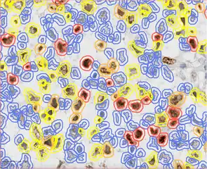 Ki67 stain calculation by QuPath in a pure seminoma, which gives a measure of the proliferation rate of the tumor. The colors represent the intensity of expression: blue-no expression, yellow-low, orange-moderate, and red-high expression.