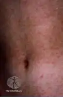 Koplik's spots