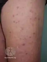 Leukemia cutis