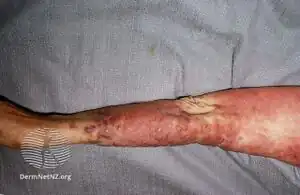 Leukemia cutis