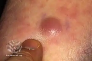 Leukemia cutis