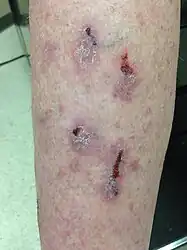 Lichen planus on the shin