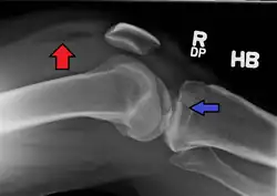 Lipohemarthrosis due to a tibial plateau fracture