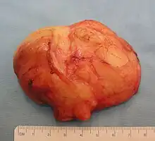 The resected lipoma(8&nbsp;cm × 6&nbsp;cm × 3&nbsp;cm)