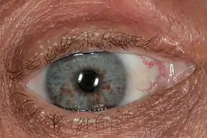 Lisch nodules as seen in NF1