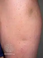 Lupus panniculitis