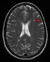 Multiple sclerosis as seen on MRI