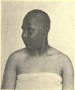 Trigonocephaly in case of microcephaly