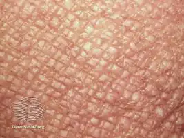 Moderate lichenification