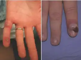 Left: mpox Right: Orf