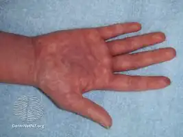 Morbilliform  eruption