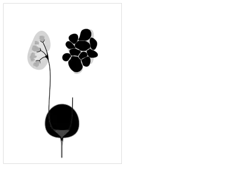 Multicystic dysplastic kidney - affects only one side; the other kidney is usually healthy.