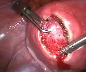 Treatment of an intramural fibroid by laparoscopic surgery