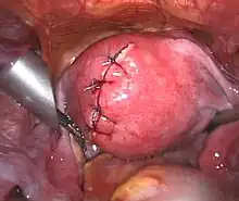 After treatment of an intramural fibroid by laparoscopic surgery