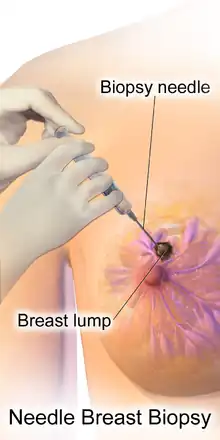 Needle breast biopsy.