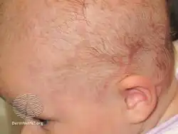 Neonatal lupus