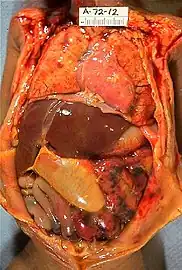 Gross pathology of neonatal necrotizing enterocolitis.