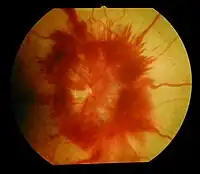 Optic disc edema and haemorrhage