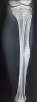 1 b. Osteoid osteoma (side view): clearly seen by high resolution CT with a small well-defined lucent nidus in the mid tibial shaft.