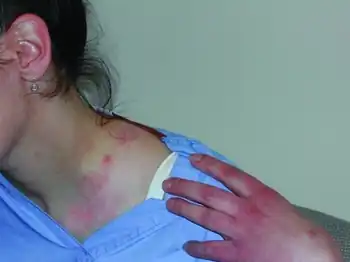 Pustule in generalized vaccinia