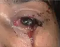 Globe rupture with protruding uveal tissue