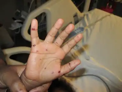 Scattered hemorrhagic vesicles