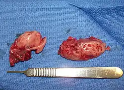 Cryptic tonsils immediately following surgical removal (bilateral tonsillectomy).