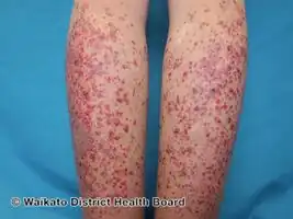 Palpable purpura